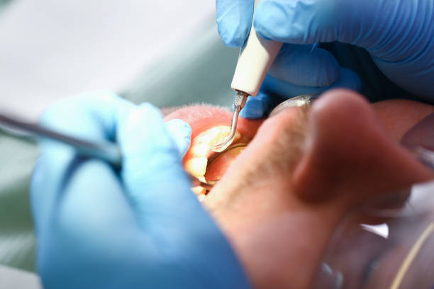 Best Emergency Tooth Extraction in Mcclure, PA